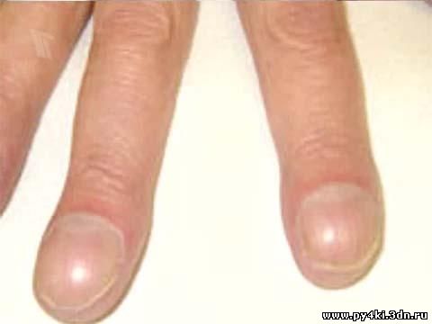 Описание деформации ногтей и фаланг пальцев