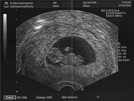 11 неделя беременности
